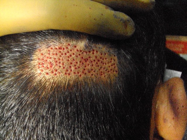 Hair Multiplication With Nigam Hair Multiplication Hairsite