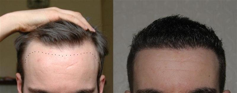 Dr reddy finasteride results