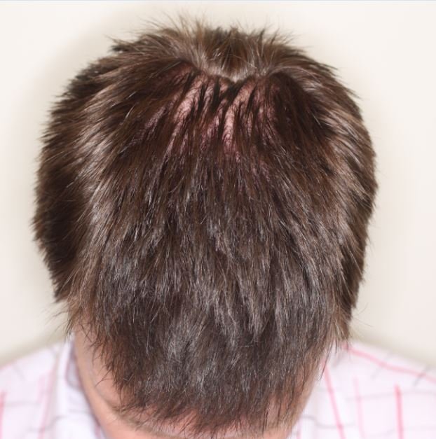 Graft Fue Result Alvi Armani Hair Transplant Hairsite