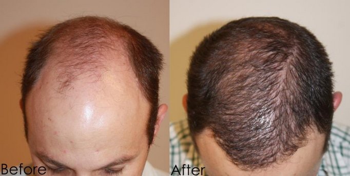 Alvi Armani Argentina result NW5 Hair Transplant HairSite