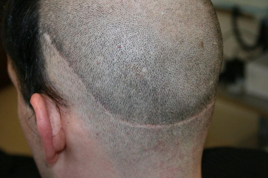 STRIP scars repair, FUE into STRIP scars - Hair Transplant - HairSite
