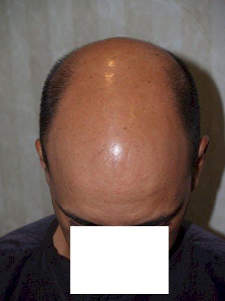 Dr. Epstein: strip hair transplant, 4400 grafts, Norwood 6 - Hair