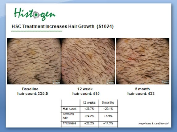 Histogen Hair