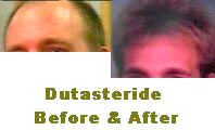 Dutasteride side effects hair