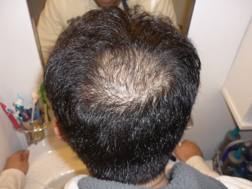 what dose of dutasteride for hair loss