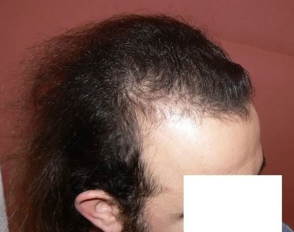 B 20 HS Id-33835 - Admin - HairSite - Hair Restoration Forum