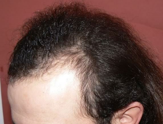 B 20 HS Id-33835 - Admin - Forum Issues - HairSite - Hair Restoration Forum