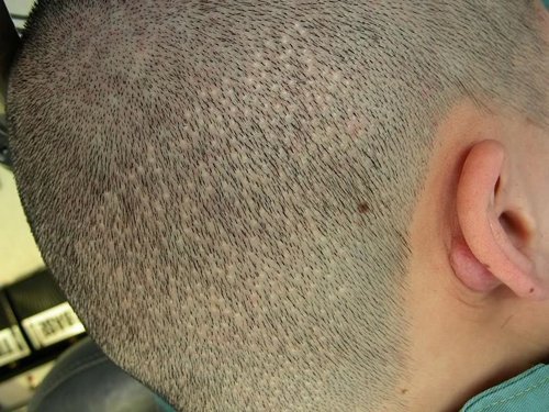 fue hair scars scarless dots loss transplant donor head sneijder wesley shave scarring hairline result hst restoration below procedures bad