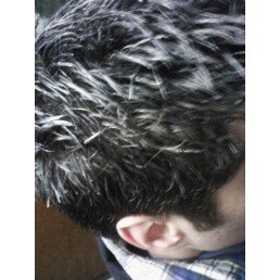 Hair Loss Forum Justin2rue S After Pix In Harsh Flourescent Office Justin2rue S After Pix In Harsh Flourescent Office Lighting