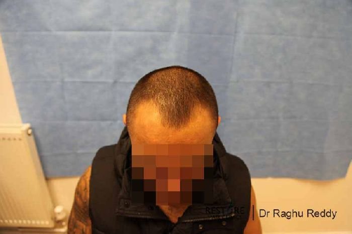 Baldness Hair Lasercomb Loss Propecia