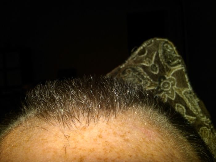 It S Saturday Night And I M Still Pretty Bald But Hair