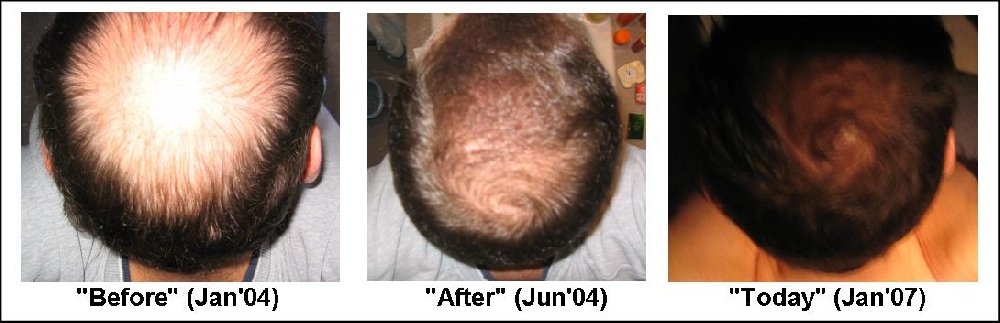dutasteride hair loss forum