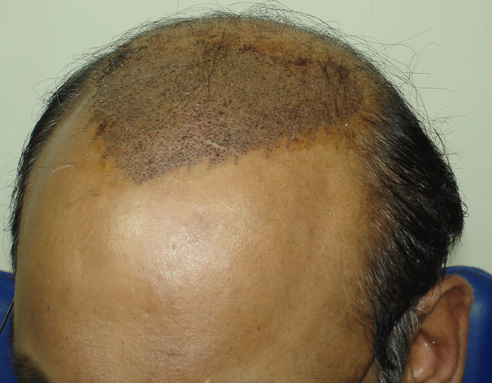 Scalp psoriasis and hair loss, the most efficient remedies ...