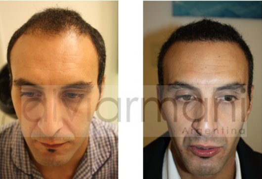 Alvi Armani Argentina Result: 2,500 grafts FUE - Hair Transplant - HairSite  - Hair Restoration Forum