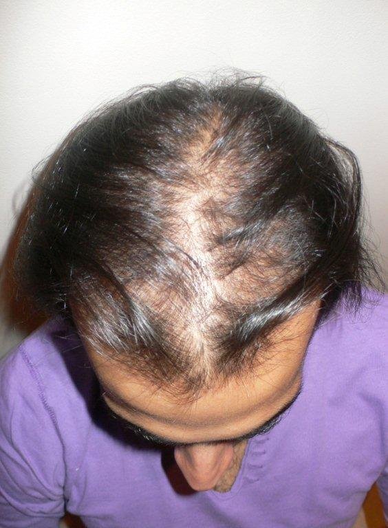 Причины выпадения волос у подростка. Экозависимая алопеция. Гиперандрогенная алопеция. Ага андрогенная алопеция.
