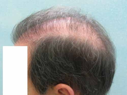 Checkingin ...back after a long absence - Hair Transplant - HairSite ...