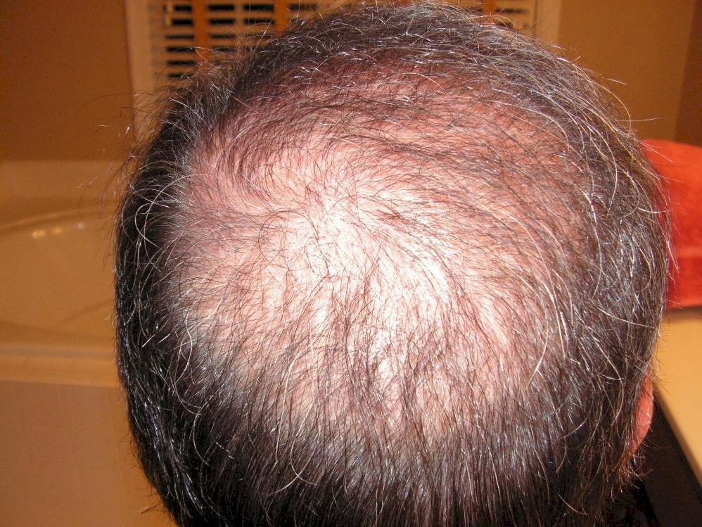 Checkingin ...back after a long absence - Hair Transplant - HairSite ...