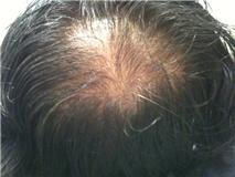 Hair Loss Forum Will Minoxidil Regrow This Crown Back 2 Yrs Of