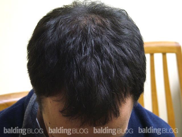 acheter finasteride