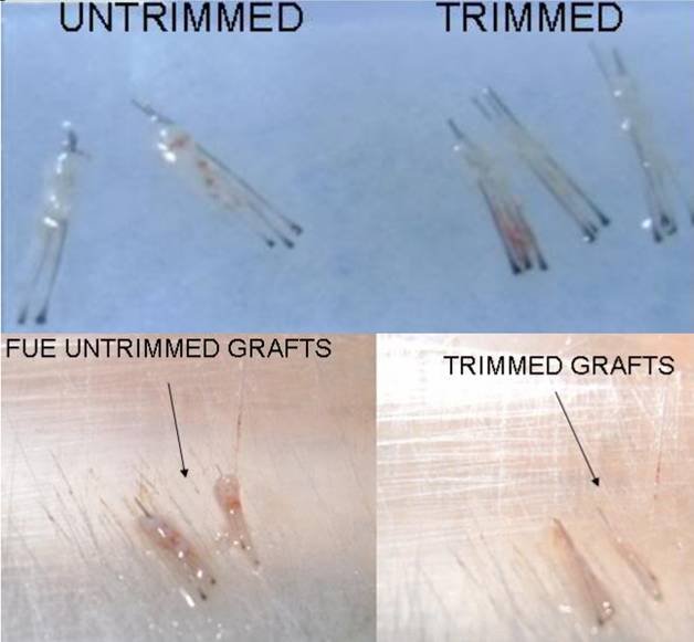 2 different Spicule theories in FUE... Hairtech - Hair Transplant ...