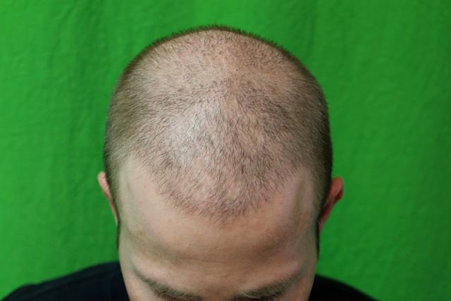 short haircut hair transplant