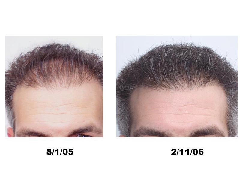 Как ускорить рост волос мужчине на голове. Финастерид Мик. Финастерид и миноксидил для волос. Топический финастерид. Финастерид 0.1 для волос.