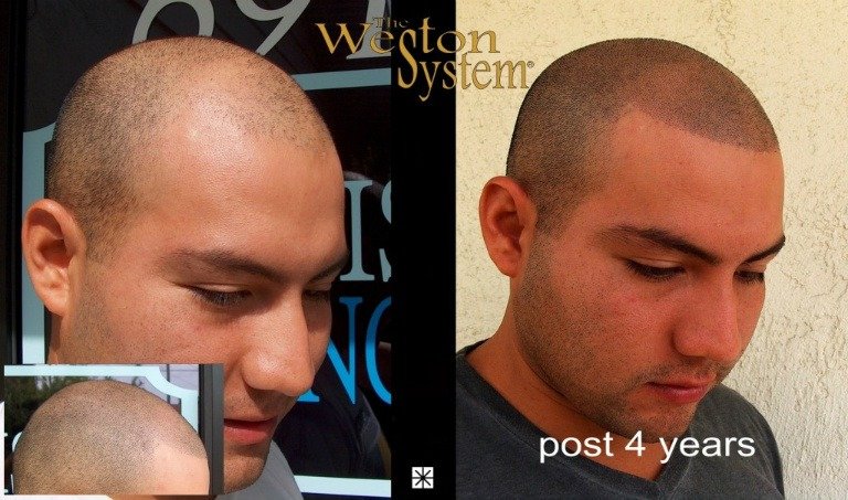 Hair Follicle Replication Scalp Micropigmentation