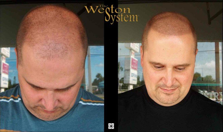 Hair Replacement Weston System