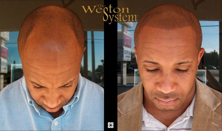 Scalp Micropigmentation African American Hair