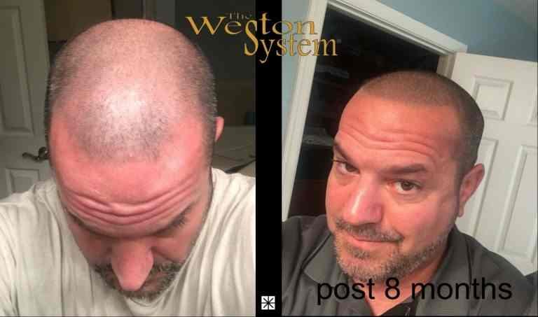 Bill Martin Hair Restoration By Weston System