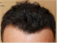 Dr. Mwamba vertex crown hair restoration