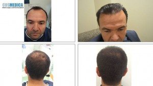 cosmedica-hair-transplant-photos-turkey-14