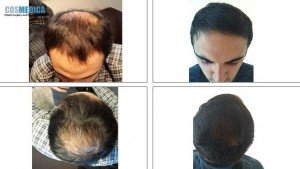 cosmedica-hair-transplant-photos-turkey-15