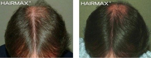hairmax-men-result-