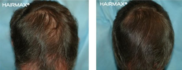 hairmax-men-result-