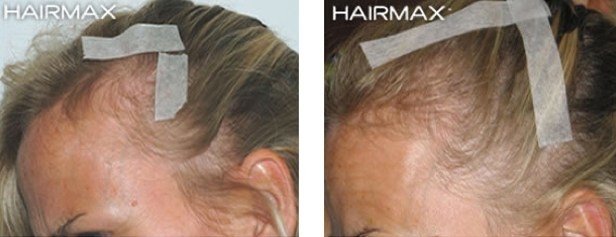 hairmax-women-result