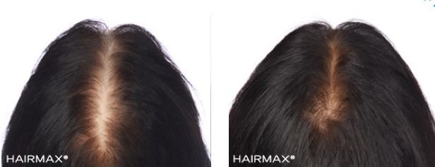 hairmax-women-result