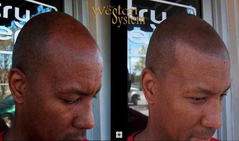 Scalp MicroPigmentation Review - SMP Hair Loss Treatment for Men
