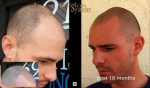 Robert Anzalone Joe Taylor Hair Restoration