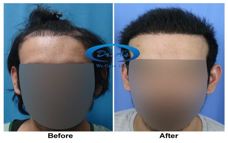 a-dr-arvind-poswal-hair-transplant-tourism-results-4
