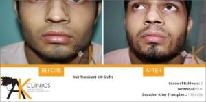 beard-transplant-result-2