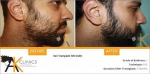 beard-transplant-result