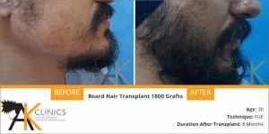 beard-transplant-result-4
