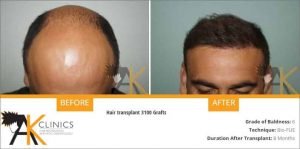 bio-fue-hair-transplant-result-9