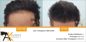 bio-fue-transplant-result-8