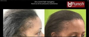 Black Women Hair Transplant