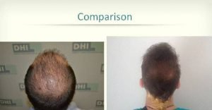 dhi hair transplant reviews