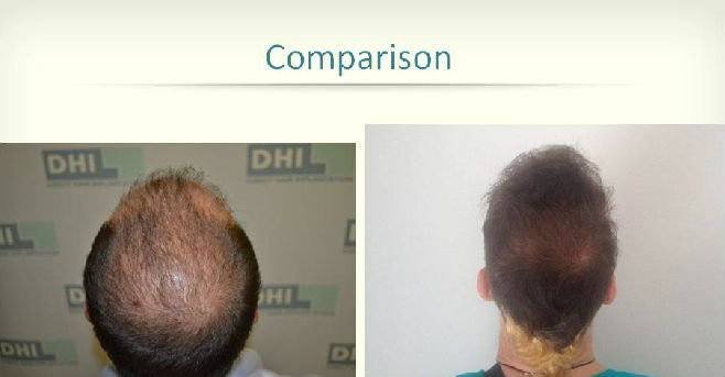 Dhi Hair Transplant Reviews 3 