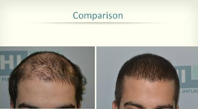 DHI hair transplant review images 