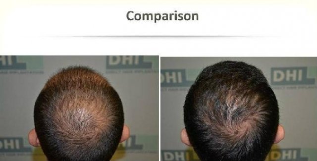 dhi hair transplant reviews